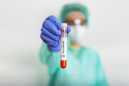 Najnowsze wiadomości o Czy Monkey-pox podąży drogą Covid-19?